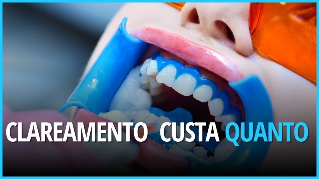 Quanto custa clareamento dental