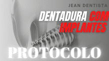 Prótese protocolo com implantes – Dentadura fixa