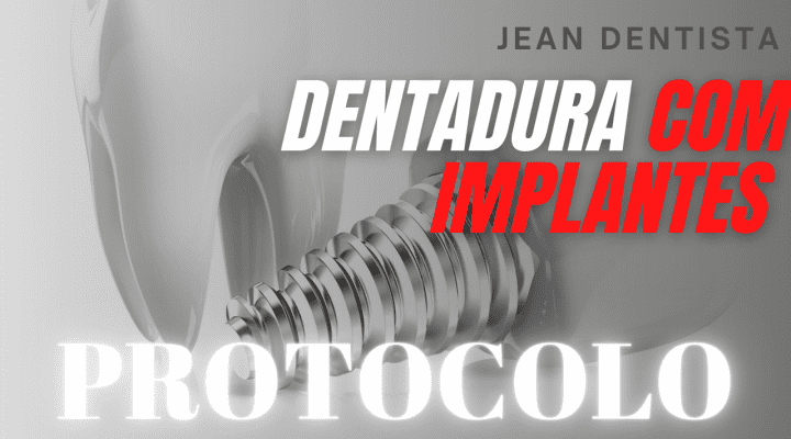 Prótese protocolo com implantes – Dentadura fixa