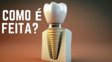 Coroa de porcelana no implante dentário