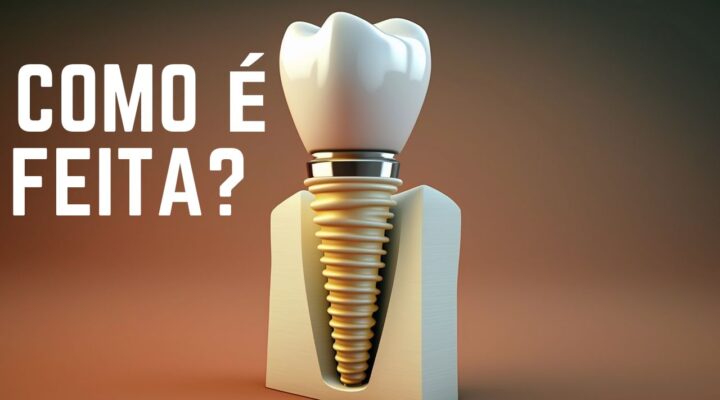 Coroa de porcelana no implante dentário