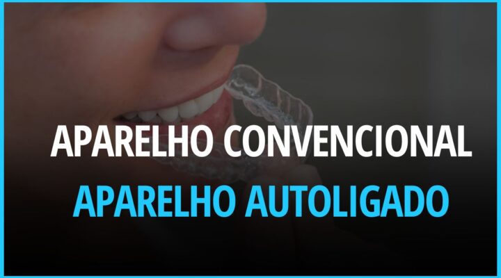 Aparelho ortodôntico convencional é pior que o aparelho autoligado ?