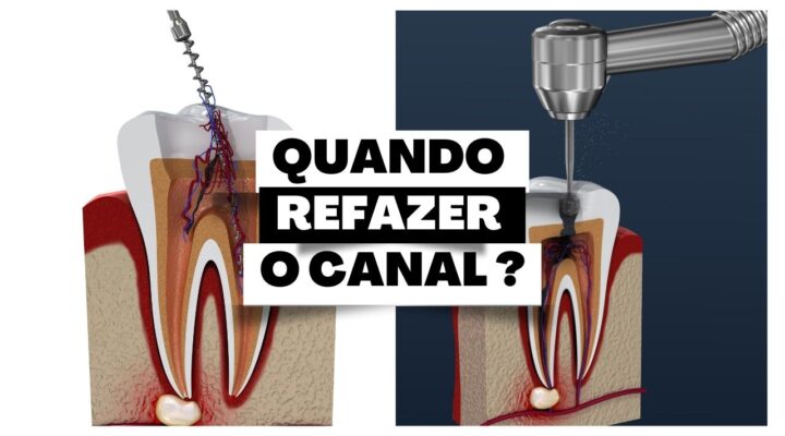 Retratamento de Canal : Quando fazer de novo o canal do dente?