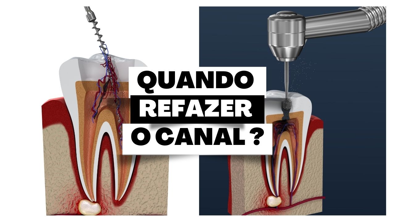 Retratamento de Canal