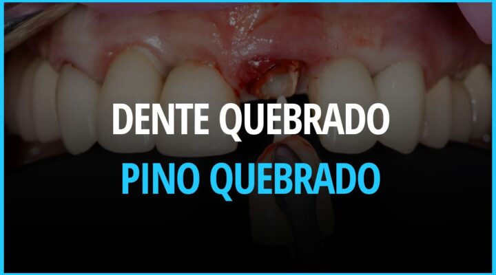 Dente Quebrado : Como lidar com pino quebrado e coroa de porcelana danificada