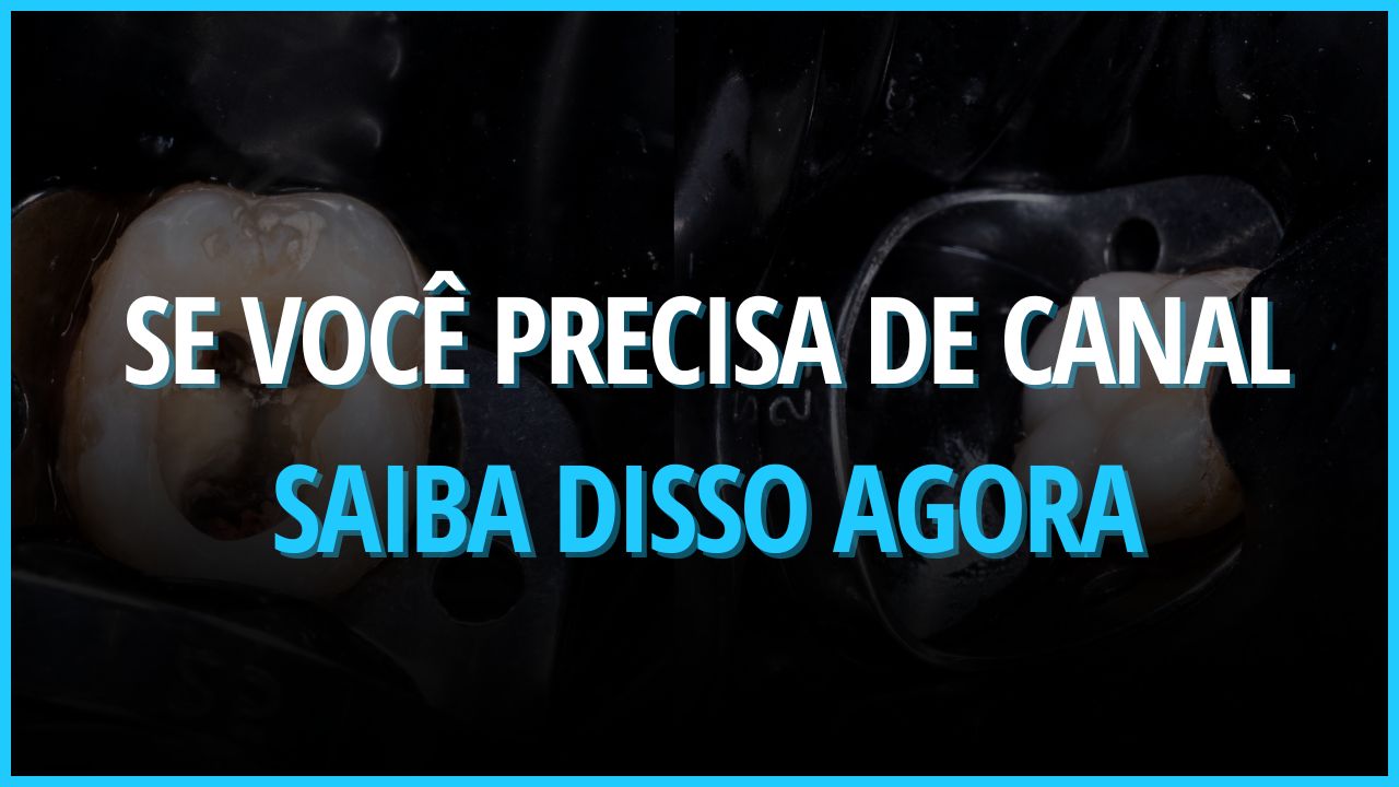 Sobre Tratamento de Canal