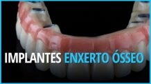 Enxerto ósseo para Implante Dentário