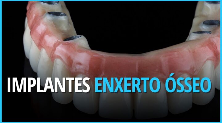 Enxerto ósseo para Implante Dentário