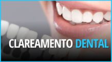 Clareamento Dental: O Guia Completo para um Sorriso mais Branco do jeito certo