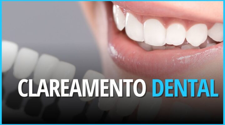 Clareamento Dental: O Guia Completo para um Sorriso mais Branco do jeito certo