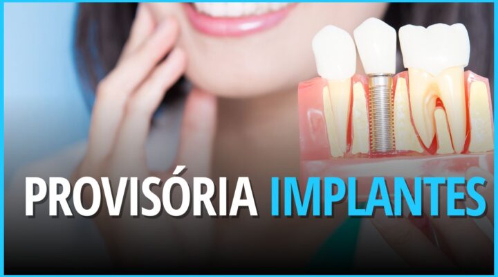 Coroas provisórias em implantes dentários