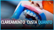 Quanto Custa o Clareamento Dental no dentista ?