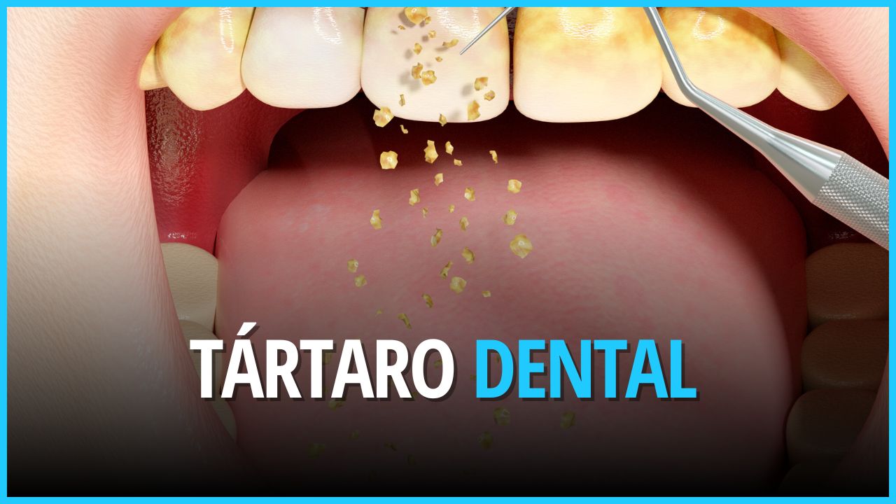Tártaro dental