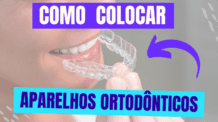 Qual dentista coloca Aparelhos?