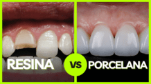 Facetas de Resina e Facetas de Porcelana