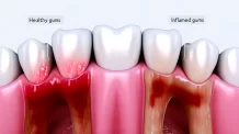 🦷 Dente Restaurado Doendo Depois de Muito Tempo: Causas, Soluções e Prevenção