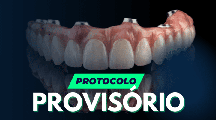 Próteses Dentárias Provisórias do Tipo Protocolo: O Que Você Precisa Saber