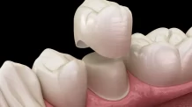 3 Tipos de Próteses Dentárias para quem perdeu dentes