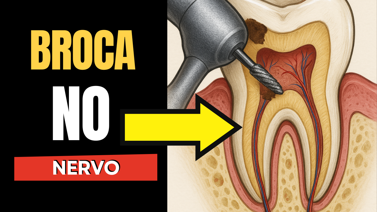 Encostou a broca no nervo do dente