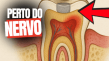A Restauração Ficou Próxima do Nervo do Dente: Dor Pós-Operatória e Possível Tratamento de Canal 🦷⚡