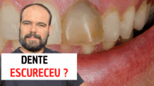 Dente Escurecido: Causas e Tratamentos