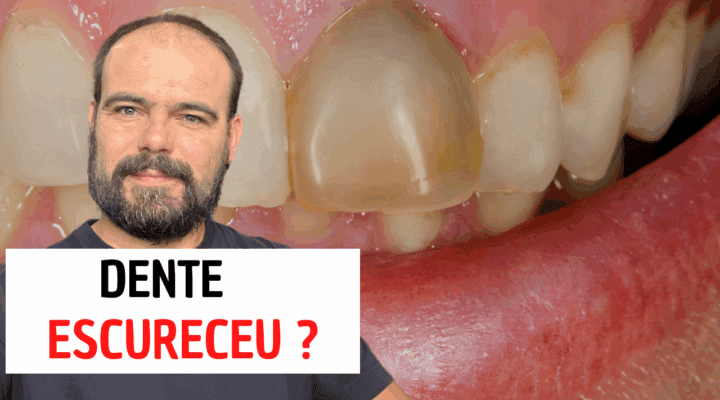 Dente Escurecido: Causas e Tratamentos
