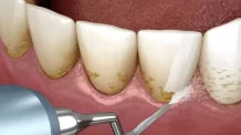 Limpeza Dental no Dentista: 10 Verdades Que Ninguém Te Conta