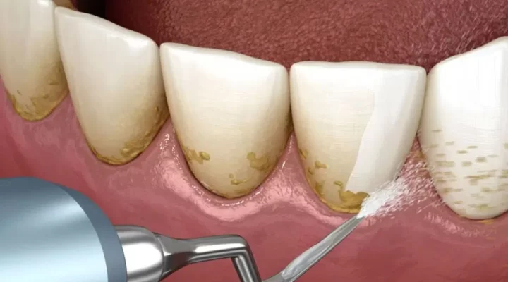 Limpeza Dental no Dentista: 10 Verdades Que Ninguém Te Conta
