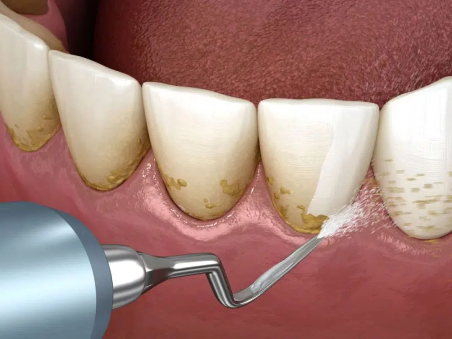 limpeza dental no dentista