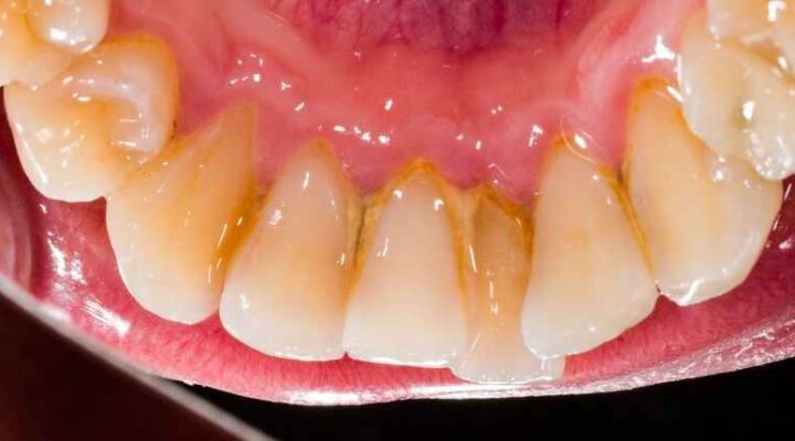 Melhor Creme Dental para Gengiva Retraída: Como Escolher e Evitar Mais Problemas