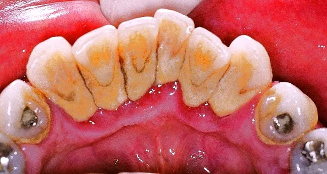 Limpeza dental regular