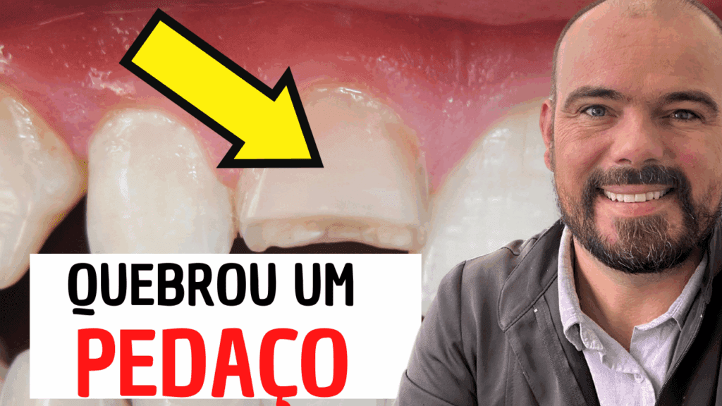 dente com canal quebrou um pedaço