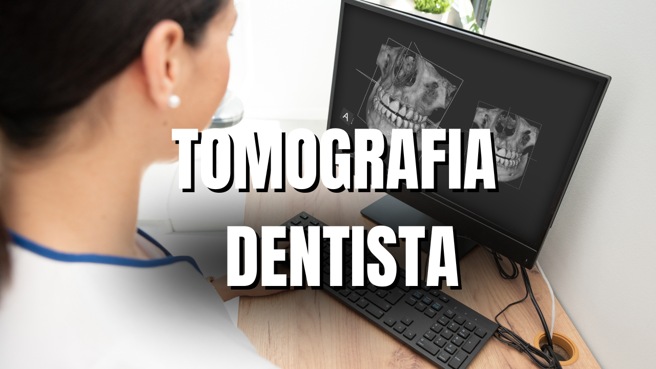 Para fazer implantes dentários precisa de tomografia? Entenda!