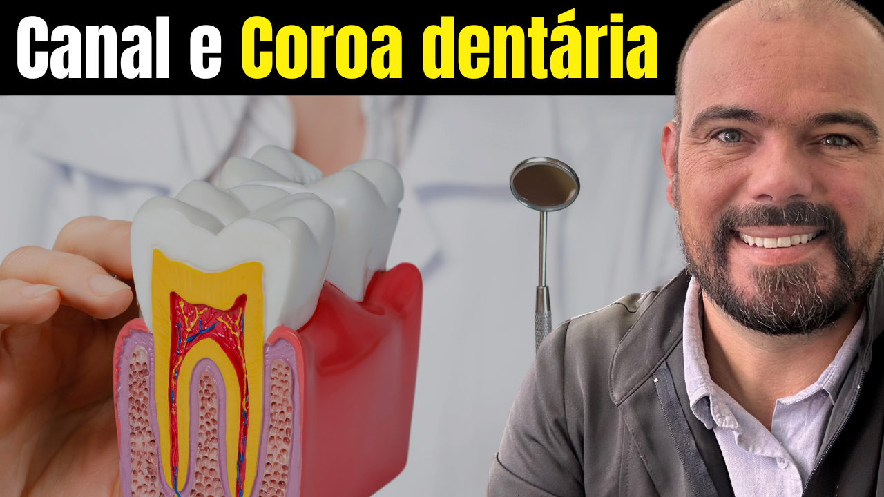 🦷 Canal ou Coroa Dentária: Quando é Preciso um, o Outro e Quando São Feitos os Dois?