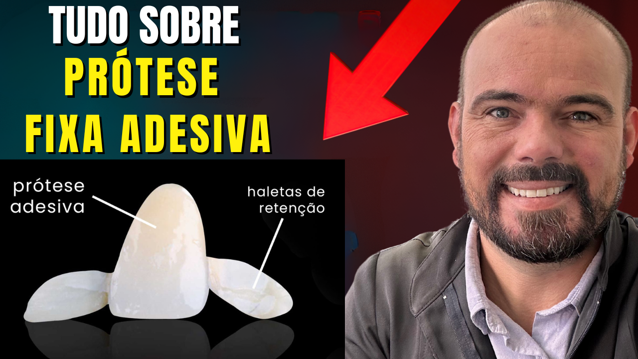 Prótese Fixa Adesiva