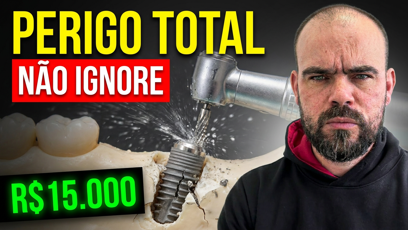 Prótese Protocolo com Implantes Dentários